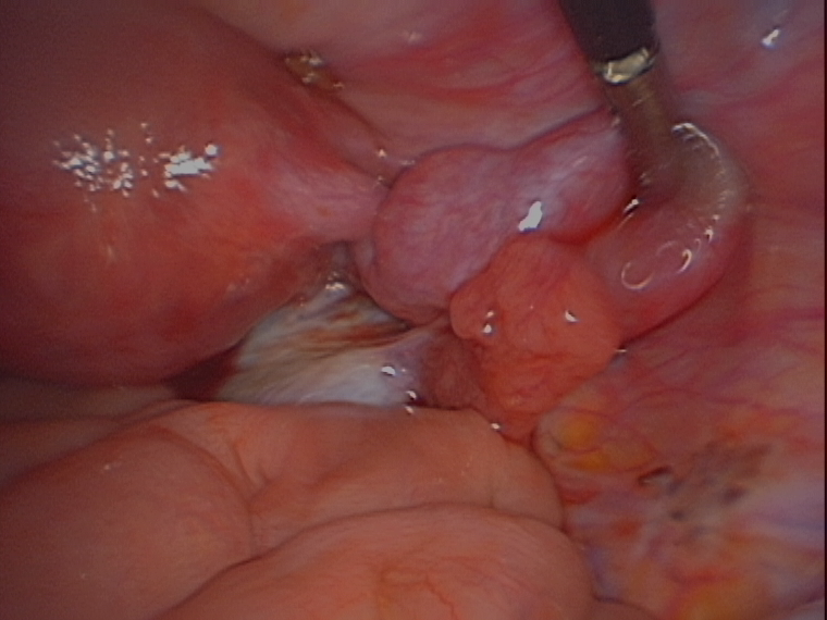 endomtriosis with right ovary stuck to back of uterus serag youssif